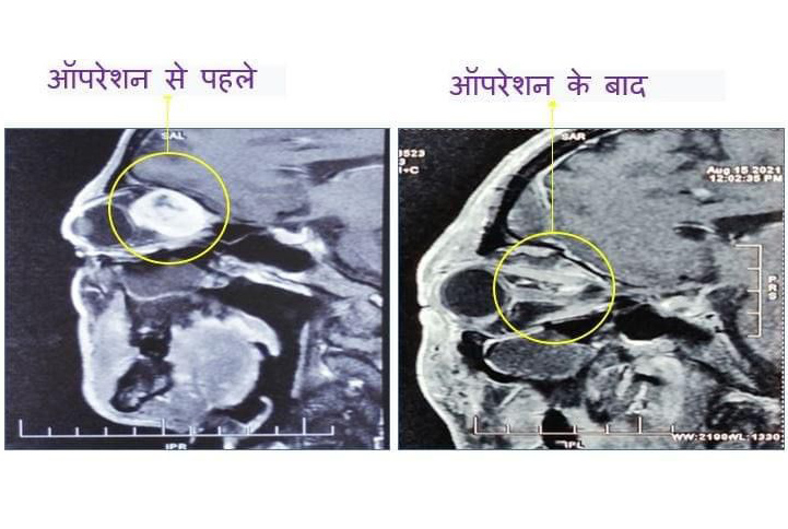 Neurologist Uttar Pradesh, Neurologist Azamgarh, Neurosurgeon in Lucknow, Neurosurgeon in Lucknow - Uttar Pradesh, Neurosurgeon in Lucknow Articles, Neurosurgeon in Lucknow Downloads, Neurosurgeon in Lucknow Blogs, Best Neurosurgeon in Lucknow Contact, Neurosurgery in Lucknow Medicines, Neurosurgery in Lucknow Uttar Pradesh, Neurosurgery Patient in Lucknow Uttar Pradesh, Neurosurgeon in Lucknow Best Case, Best Neurosurgeon in Lucknow Books, Best Neurosurgeon in Lucknow Hobbies, Neurosurgeon in Lucknow Library, www.dranoopsingh.com, India