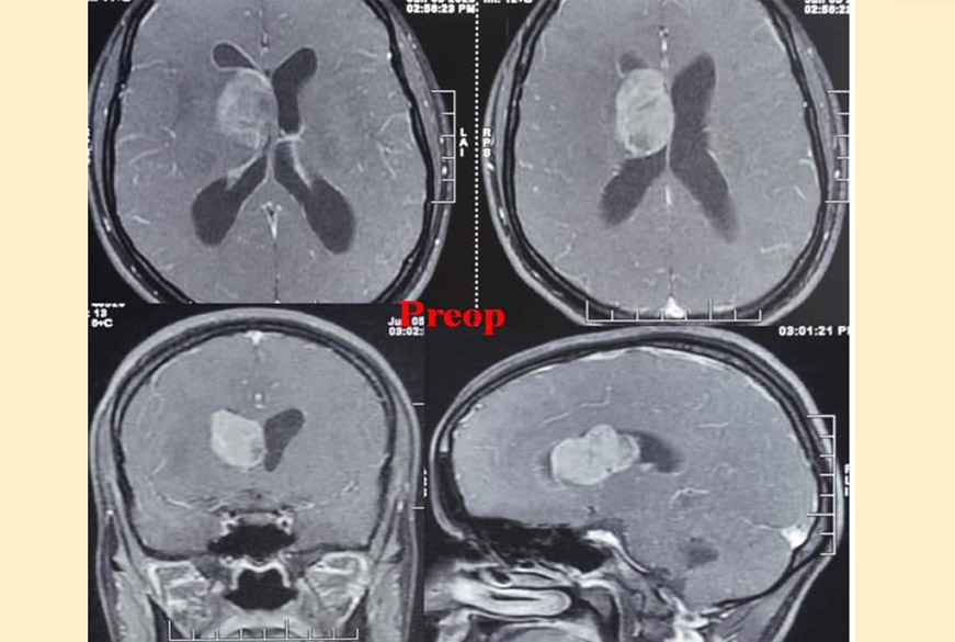 Neurologist Uttar Pradesh, Neurologist Azamgarh, Neurosurgeon in Lucknow, Neurosurgeon in Lucknow - Uttar Pradesh, Neurosurgeon in Lucknow Articles, Neurosurgeon in Lucknow Downloads, Neurosurgeon in Lucknow Blogs, Best Neurosurgeon in Lucknow Contact, Neurosurgery in Lucknow Medicines, Neurosurgery in Lucknow Uttar Pradesh, Neurosurgery Patient in Lucknow Uttar Pradesh, Neurosurgeon in Lucknow Best Case, Best Neurosurgeon in Lucknow Books, Best Neurosurgeon in Lucknow Hobbies, Neurosurgeon in Lucknow Library, www.dranoopsingh.com, India